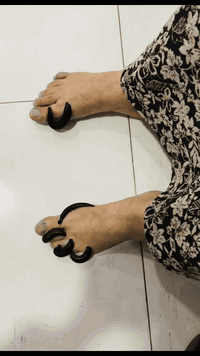 علاج بالعلق • قدم سكري • النعمانيه