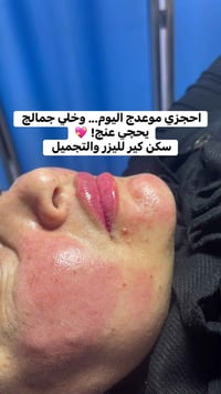 ✨ سرّ الجمال يبدأ من هنا ✨ 💉 إبرة السلمون لتجديد البشرة ومنحها النضارة...