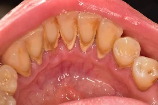 السلام عليكم ورحمه الله وبركاته 
متواجدين بأذن الله تعالى بعد العيد يومي الثلاثاء والأربعاء لتقديم خدمات طبيه مجانيه الى أهالي كربلاء الكرام 
قلع الاسنان والجذور التالفه💯
تنظيف الأسنان على بشرط وجود تكلسات 💯
عمل حشوات في حاله وجود كسر او تسوس بالأسنان الأماميه فقط💯
الموقع 📍 كربلاء - شارع السعديه - خلف مول الحارث - قرب شرطه المخيم [عيادات بيارق العميد ] التابعه الى العتبه العباسيه المقدسه 🤍
للاستفسار  على الرقم *********** 
او التواصل على الخاص
