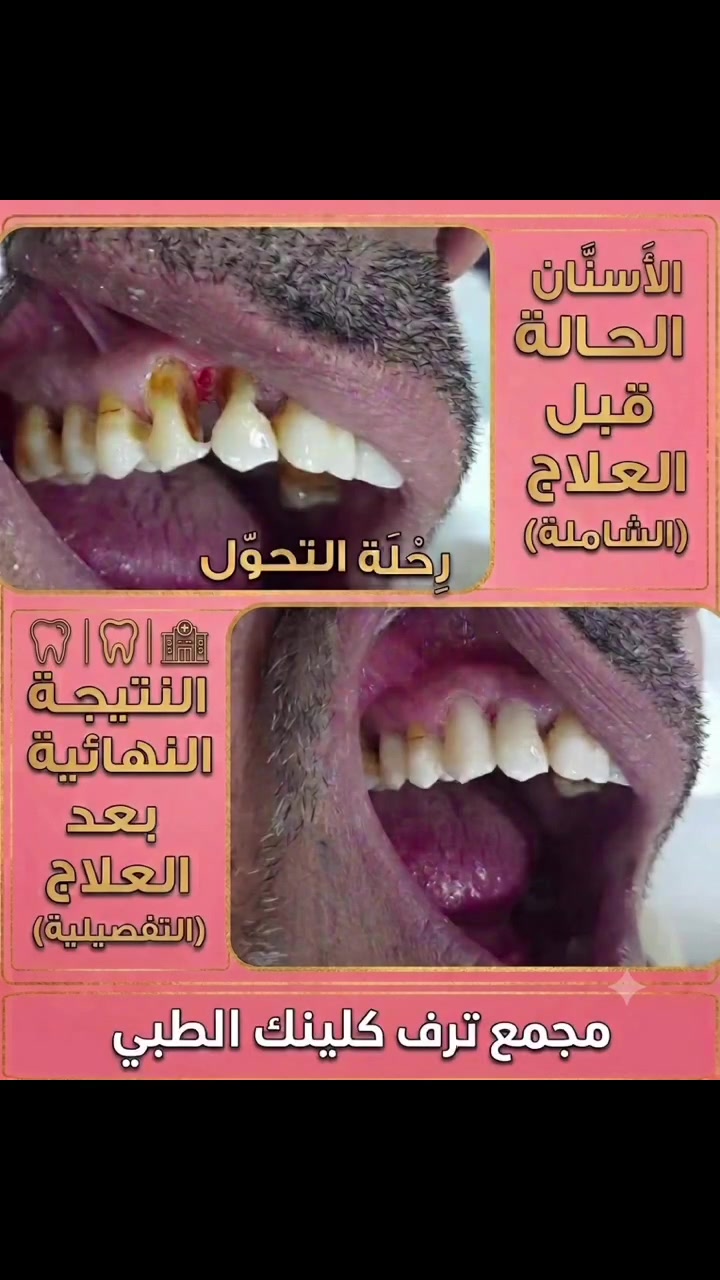 الشغل الصح✅بالمكان الصح ✅
❤️❤️❤️❤️❤️❤️❤️❤️❤️❤️

مجمع ترف كلينك الطبي.

العنوان مدينة الصدر خلف سوق العورة 
قطاع ٧١ مقابل ملعب قطاع ٣٦
للحجز والاستفسار مراسلة الصفحة أو الاتصال على الأرقام التالية ☎️ ‭***********‬

#مدينةالصدر
#اسنان
#تركيب
#حشوة
#بغداد
