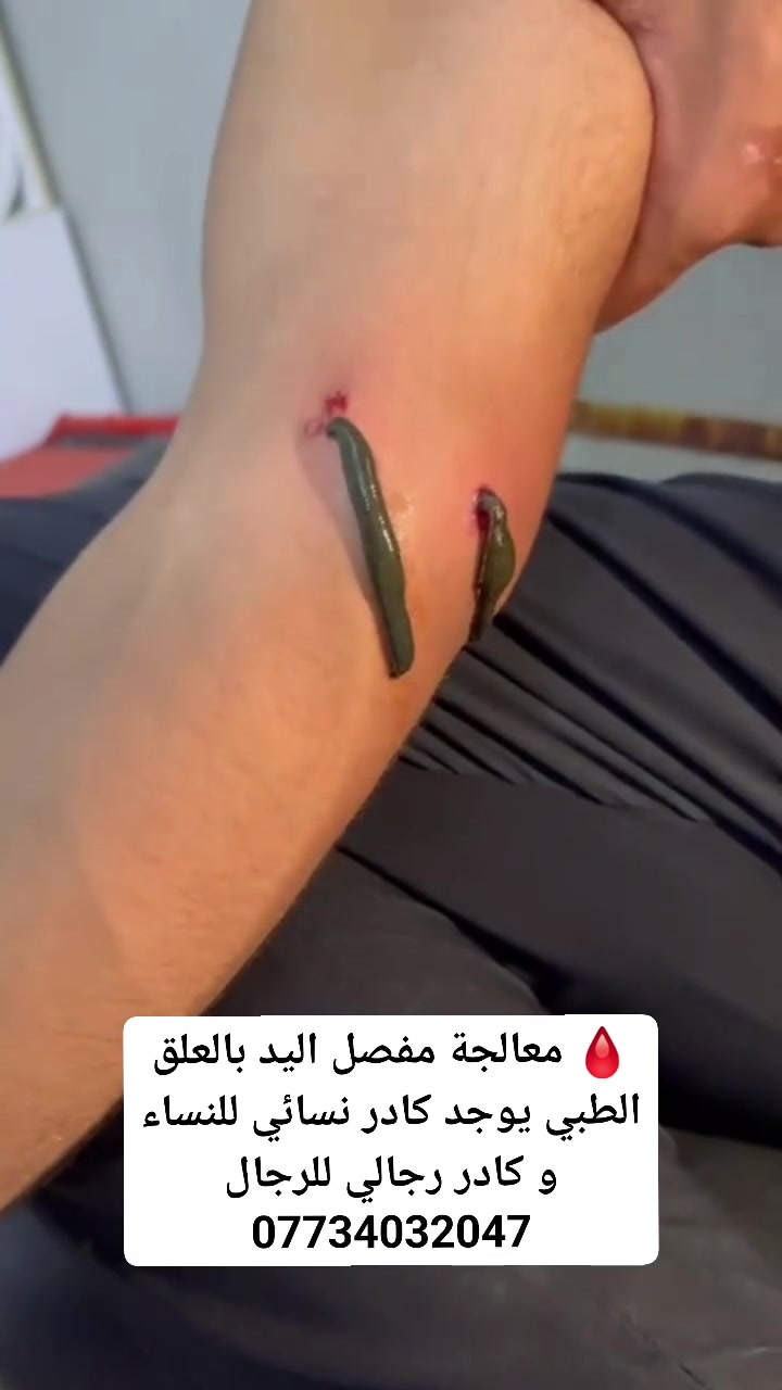 🩸 معالجة مفصل اليد بالعلق الطبي

تُستخدم المعالجة بالعلق الطبي في بعض حالات آلام ومشاكل مفصل اليد، وقد تساعد على:
✅ تحسين الدورة الدموية حول المفصل.
✅ المساعدة في تقليل الاحتقان والتورم.
✅ المساهمة في تخفيف الألم لدى بعض الأشخاص.
✅ دعم حركة المفصل وتقليل الشعور بالتيبس.
✅ المساعدة في تحسين وصول الدم إلى الأنسجة المحيطة بالمفصل.

📍 العنوان: محافظة واسط – قضاء النعمانية – شارع 13 – مقابل صيدلية علاء حسين كريم.
👩‍⚕️ يوجد كادر نسائي للنساء وكادر رجالي للرجال.
📞 للحجز والاستفسار: ***********

#العلق_الطبي #مفصل_اليد #آلام_المفاصل #الطب_البديل #النعمانية #واسط
 #الجميع 
 #متابعين 
 #اشارة 
 #الكل 
#everyone  
#followers
