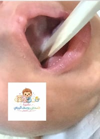 قلاع فموي • طفلة شهرين • عيادة ضحى يوسف