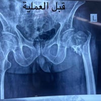 مريضة تبلغ من العمر٧٤سنة تعرضت لحادث سقوط على اثرها تعرضت لكسر في اعلى...