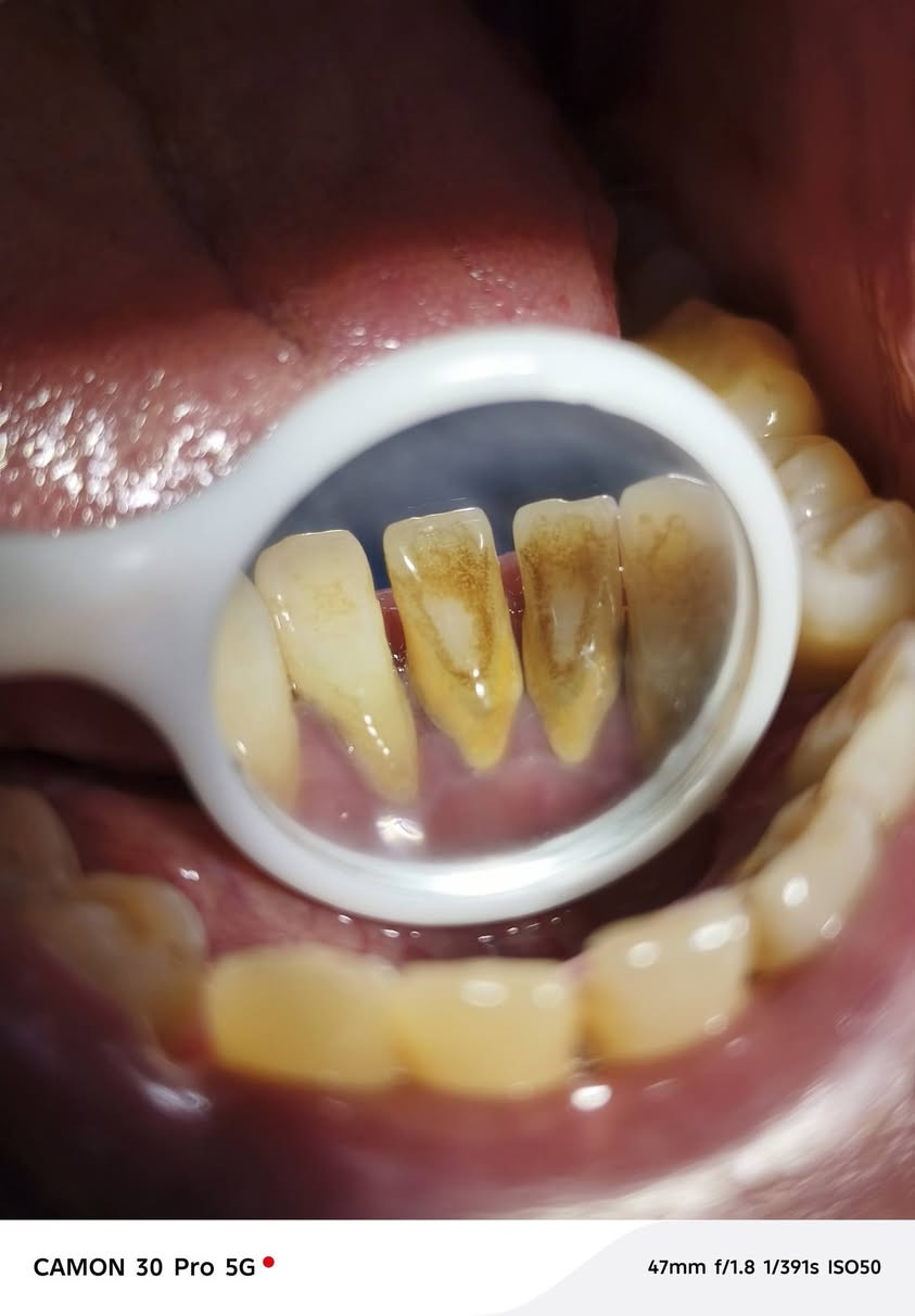 حياكم الله اخوان
علاج اسنان مجاني يشمل تنظيف وحشوات وقلع 
للاستفسار والحجز خاص او اتصل *********** 
عنوان العيادة شارع ٤٠ مجاور جامع ابو خمرة واهلا وسهلا بكم
