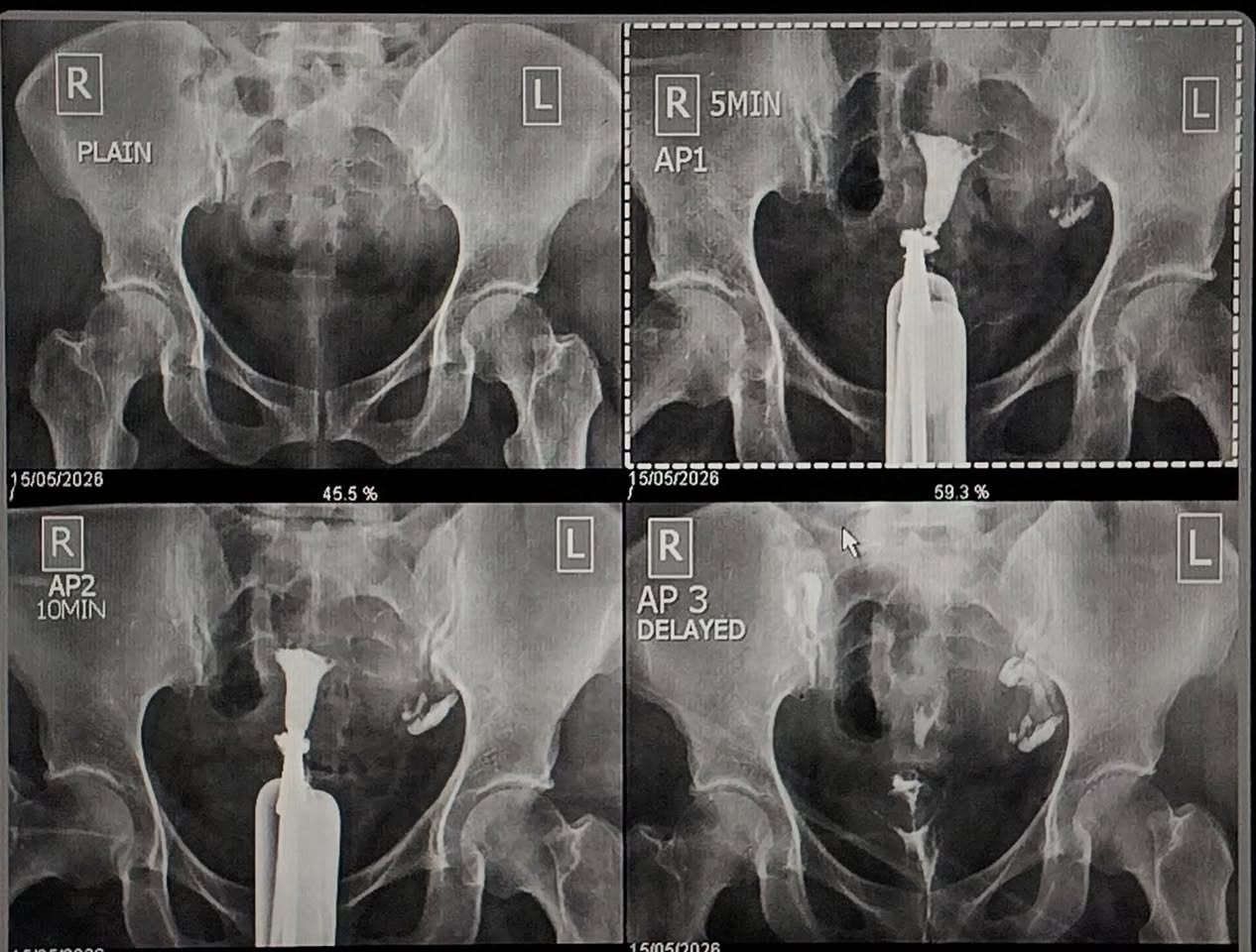 تخافين من الاشعة الملونة للرحم 💔

وفرنا الفحص بالبنج العام تحت اشراف كادر تخدير مختص ، يعني ما راح تحسين بأي شي اثناء الفحص 🥰

وهاي الصور لبعض حالتنا الي سوينها الفترة الفاتت 

للحجز و الاستفسار 
*********** ( اتصال - واتساب) 

#H_S_G #الأشعة #اشعة_ملونة_للرحم #الحمل #العقم #البنج_العام
