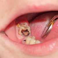 قلع الأسنان -مجاناً ان شاء الله متواجدين  الان على هذ الرقم بالواتساب ...