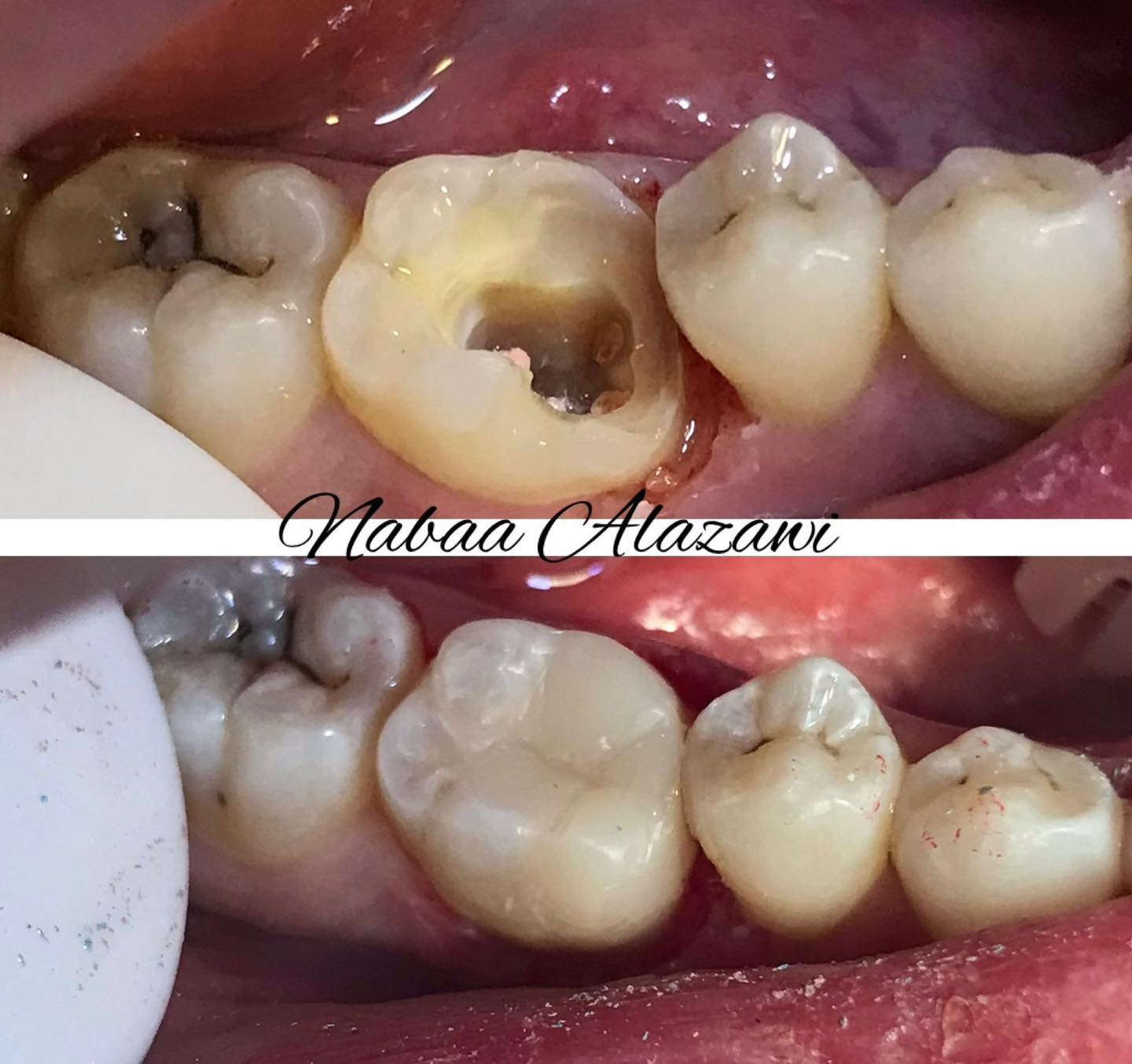 الى/ اهالينا في المجمع السكني النفطي والمناطق المجاورة

إعلان افتتاح عيادة أسنان 🦷

تعلن عيادة : (جوري) لطب الاسنان والتجميل
عن افتتاحها رسميًا وتقديم أفضل الخدمات العلاجية والتجميلية بأحدث الأجهزة والتقنيات الحديثة.

🔹 فحص وتشخيص دقيق
🔹 حشوات وتجميل الأسنان
🔹 تنظيف وتبييض
🔹 خلع وعلاج جذور
🔹 ابتسامة صحية باشراف طبي  متخصص
🔹تقويم الاسنان و بنظام الاقساط
اضافة الى عروض قسم التجميل والبوتوكس 
📍 العنوان: عمارة الكناني
📞 للحجز والاستفسار:***********
