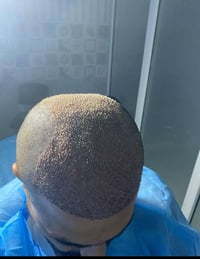 زراعة الشعر • الناصرية • بصيلات مفتوحة