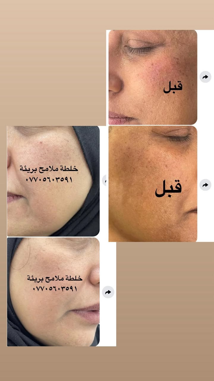 عليها القرأن الي مجربه براندي خلطة ملامح بريئة وفايدها تعلق اهنا بنات يتابعون التعليقات يردون يستخدموهاويستفسرون منكم  👈🌹


**إذا كنت صاحب هذا الإعلان وتريد حذفه لأي سبب، رجاءا أرسل رسالة إلى الدعم الفني**