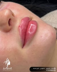 ✨ حقن فلر الشفاه لشفاه ناعمة، ممتلئة وطبيعية 💋 🌸 تحديد شكل الشفاه بدقة...