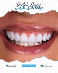 تريد أبتسامه هوليوود طبيعية مُشرقة؟  دنتل هاوس تقدملك أفضل خدماتها حتى...