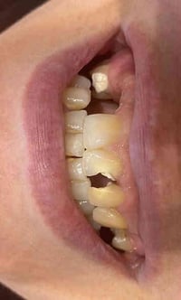 الزاركون ألماني • تعويض أسنان • حي النصر