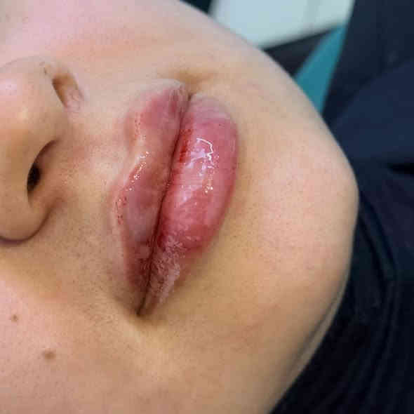 أذابه فلر محقون بطريقه غلط  متكتل وصاعد ع منطقه الشارب وتجديد الحقن❤️‍🔥😍 +اسحبو جان تشوفون باقي الجمال 🔥 المسيب *********** 

#فلر_شفايف #فلرشفة_فلر_وجنات_فلرخطوط_ضاحكة_فلرذقن_تكساس_تكنيك❤️❤️❤️ #الشعب_الصيني_ماله_حل😂😂
