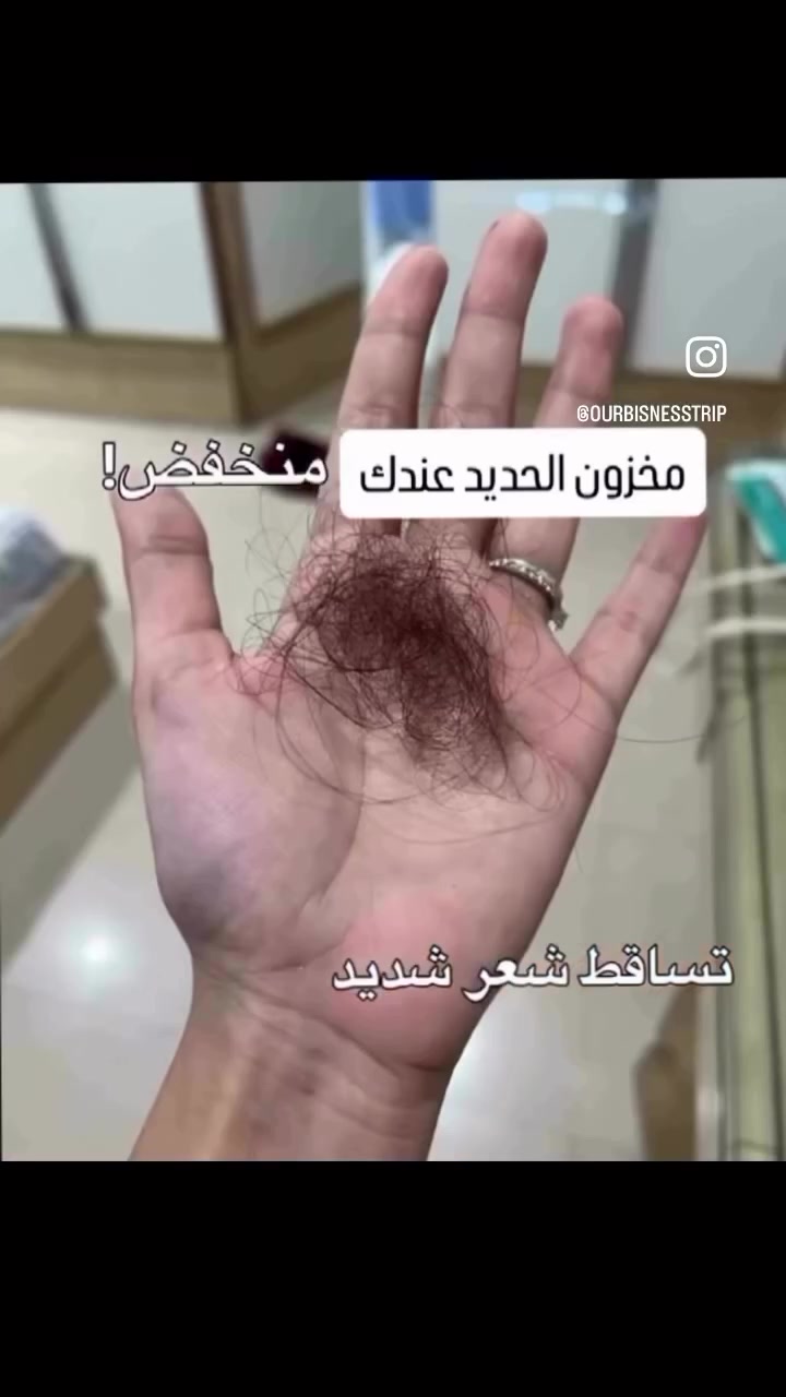 تعب، شحوب، وخمول؟ جسمك يطلب المساعدة! 🩺✨
كثير من الفئة الشبابية يعانون من أعراض نقص الحديد وهم ما يعرفون.. تساقط الشعر، الهالات السوداء، وضعف التركيز كلها علامات تدل إن مخزون الطاقة عندكِ يحتاج إعادة تعبئة.
كصيدلانية، دائماً أنصح بمنتج يجمع بين الفعالية والامتصاص الصحيح. فيديو اليوم عن Forever Daily:
• ليش هذا المنتج؟ لأنه يحتوي على كمية مثالية من الحديد المدعم بفيتامين C لضمان أعلى نسبة امتصاص.
• أكثر من مجرد حديد: يحتوي على 55 عنصراً غذائياً وفيتامينات (A, C, D, E, B12) اللي تحول تعبك إلى نشاط وبشرتك الشاحبة إلى بشرة مشرقة.
• خلاصة الطبيعة: يحتوي على مزيج FVX20 من الخضروات والفواكه، يعني تغذية حقيقية للجسم.
النتيجة؟ طاقة تخدمك طول اليوم، وشعر وأظافر أقوى، ونضارة تلاحظينها بالمراية.
📍 متوفر الآن.. للطلب أو الاستفسار عن الجرعة المناسبة لحالتك، راسليني على الخاص.
#نقص_الحديد #صحة_المرأة# #فوريفير_دايلي #نضارة صيدلانية تغذية_سليمة خمول


**إذا كنت صاحب هذا الإعلان وتريد حذفه لأي سبب، رجاءا أرسل رسالة إلى الدعم الفني**