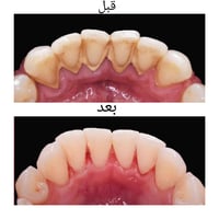 ⚠️ جير الأسنان يسبب: نزيف وتراجع باللثة وسقوط الأسنان بالاخير  الحل؟ ت...