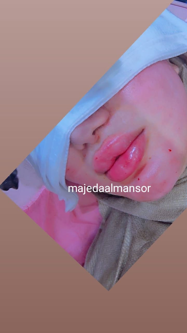 بكج الانوثه 
فلر وجنات  + حنك 
ابرة ماكس الفيتامينات الايطاليه
فلر شفه
فقط 200 الف
مجمع سماء الحسينيه الطبي قسم التجميل والليزر مع الخبيرة المتميزه والمدربه المعتمده دوليا ماجده المنصور العنوان بغداد الحسينيه مقابيل السوق الكبير مجاور مرطبات العذراء مجمع سماء الحسينيه الطبي طابق ثاني قسم التجميل والليزر والصالون للحجز والاستفسار *********** Jojo Alnabeel 
#ماجدة_المنصور #فلرخدود #فلر_وجنات_شفاه #الحسينيه_الراشديه #بغداد_العراق @مجمع سماء الحسينية الطبي 🍂
