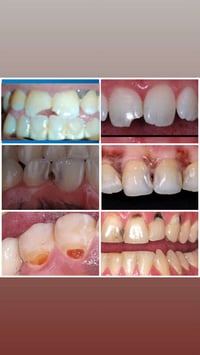 علاج اسنان مجاني • تسوس • عيادات جامعة الحلة