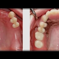 طقم جزئي متحرك • جامعة المعارف كلية طب الأسنان • أسعار رمزية