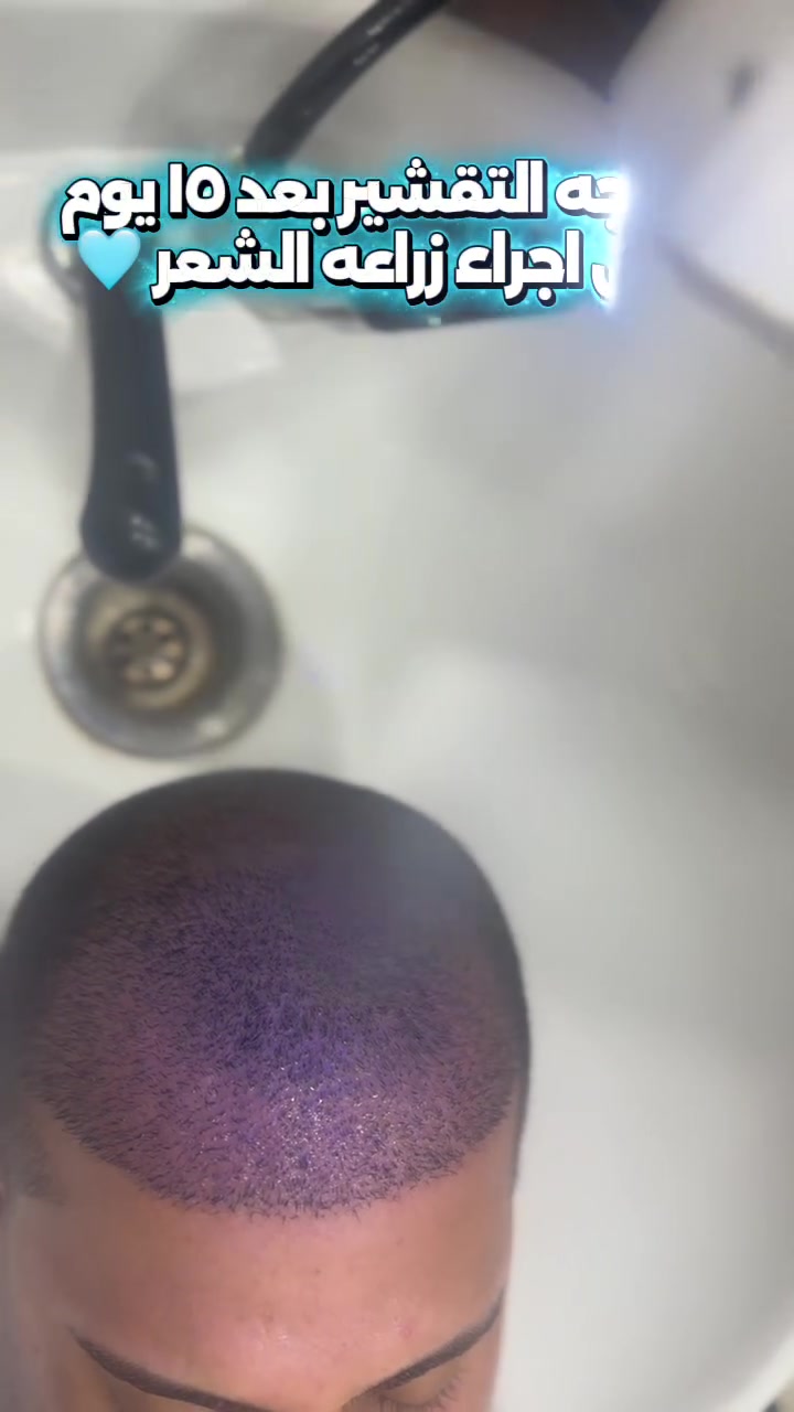 بعد ١٥ يوم بس من زراعة الشعر
مرحلة التقشير  تخلص ☑️
والفروة تبدي تتنفس☑️
والنتيجة تبين نظيفة وطبيعية 👌

هاي مو نهاية الرحلة… هاي البداية الصح لكثافة أقوى وشعر يرجعلك ثقتك خطوة خطوة

كل هذا بفضل خبرة الكادر الطبي 
وتقنيات مدروسة
 تضمن أفضل بداية لرحلة كثافة صحية وطبيعية ترجعلك ثقتك بنفسك🫵🏻🩶

للحجز والاستفسار 
***********
 او زورونا بموقع العياده 🟦 بغداد المنصور شارع الرواد مقابل مرطبات مشمشه
