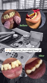 تنظيف اسنان • علاج مجاني