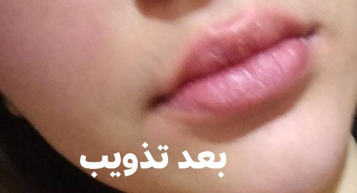 تذويب فلر قديم متكتل وحقن فلر جديد من اعمالي الماكيره هدو صالون هوى بغداد الرياض شارع الحلاقين مقابل ازياء عسوله للحجز والاستفسار ***********
