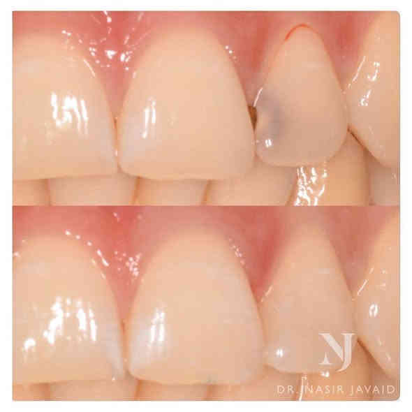 الي عندة مثل هاي الحالات ومحتاج حشوات أو قلع للاسنان والجذور المتبقية العلاج مجاني داخل عيادات جامعة واسط وبأشراف اطباء مختصين
تواصلوا وياي  عالواتساب او التليجرام 

***********
