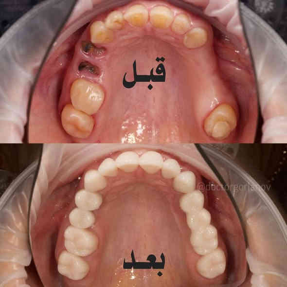 السلام عليكم..
🟢 خدمـــة مجــانية 

1⃣ قلع جذور الاسنان المتبقية ✅

2⃣ تعــويض الاسنان المفقودة بطقم جزئي متحرك ✅

الموقع بغداد كرادة شارع 52 عيادات جامعة اوروك

التواصل خاص او واتساب ***********
