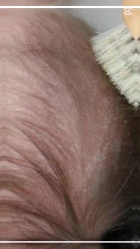 علاج فطريات الشعر عند الأطفال🥀🥀🩷

فطريات الشعر أو سعفة الرأس عند الأطفال هي عدوى فطرية تصيب فروة الرأس والشعر، وتحتاج علاجًا مبكرًا لمنع انتشارها أو حدوث تساقط دائم للشعر.
العلاج الطبي:🫪
1. الأدوية المضادة للفطريات
غالبًا يحتاج الطفل إلى أدوية فموية يصفها الطبيب، لأن الكريمات وحدها لا تكفي لعلاج فروة الرأس.
من الأدوية المستخدمة:
Griseofulvin
Terbinafine
مدة العلاج عادة من 4 إلى 8 أسابيع حسب الحالة.
2. الشامبو العلاجي🥀🥀
يستخدم مع العلاج الدوائي لتقليل انتشار الفطريات، مثل:
شامبو يحتوي على الكيتوكونازول
أو السيلينيوم سلفايد
ويُستعمل عدة مرات أسبوعيًا حسب تعليمات الطبيب.
العناية بالطفل أثناء العلاج
غسل الشعر بانتظام🤍
عدم مشاركة الأمشاط أو المناشف🤎
غسل أغطية الوسائد والقبعات🤍
قص الأظافر لمنع خدش فروة الرأس🩷
فحص أفراد العائلة إذا ظهرت أعراض مشابهة🤍
متى يجب مراجعة الطبيب بسرعة؟🥀

إذا ظهر تورم أو صديد
ارتفاع الحرارة
زيادة تساقط الشعر
عدم التحسن بعد العلاج
هل يعود الشعر للنمو؟🤷🤷
نعم، في أغلب الحالات يعود الشعر للنمو بعد الشفاء، خاصة عند بدء العلاج مبكرًا.
الوقاية:
الاهتمام بالنظافة الشخصية
تجنب مشاركة الأدوات الشخصية
علاج الحيوانات الأليفة المصابة
الحفاظ على جفاف فروة الرأس ونظافتها،،🤩🤩
تحياتي د اسيل سعيد عزيز 🥰 
للتواصل وتساب 🥀 
#***********
