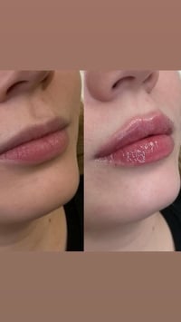 فلر شفة ب50 الف عروض لمدة اسبوع  للحجز/ 07852991170