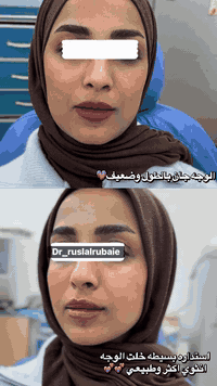 شغل طبيبتنا المبدعة د رسل متواجد جميع الايام النظام الحجز ضروري قبل يو...