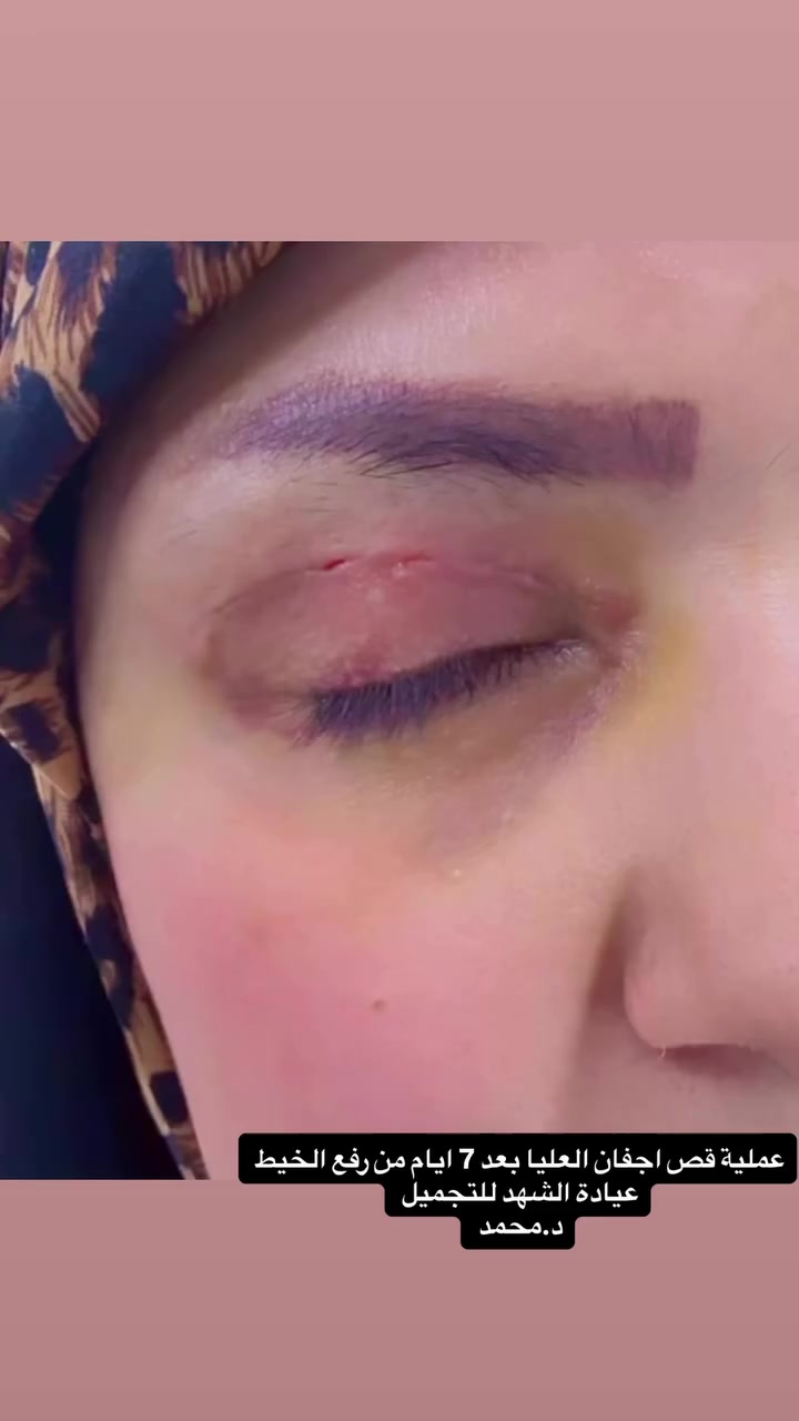 ✨🌙 عروض رمضان – عيادة الشهد للتجميل 🌙✨

بمناسبة شهر الخير، خصومات خاصة لفترة محدودة ✨

🔹 العمليات الجراحية:
▪ قص الأجفان العليا – 250
▪ قص الأجفان السفلى – 350
▪ تصغير فتحات الأنف – 350
▪ شد وجنات جراحي – 400
▪ رفع الحاجب جراحي – 350
▪ سحب العين – 300
▪ عين القطة – 350

💉 الفيلر:
▪ فلر شفة فرنسي – 75
▪ فلر شفة إيطالي – 90
▪ فلر شفة سويسري – 125

🌟 تغيير شامل – 350

📍 العناوين:
الفرع الأول: بغداد – شارع فلسطين
الفرع الثاني: بغداد – بسماية – الشارع العام

📞 للحجز والاستفسار:
***********

رمضان فرصة للتجدد ✨ إطلالة جديدة وثقة أكبر بانتظاركم �
