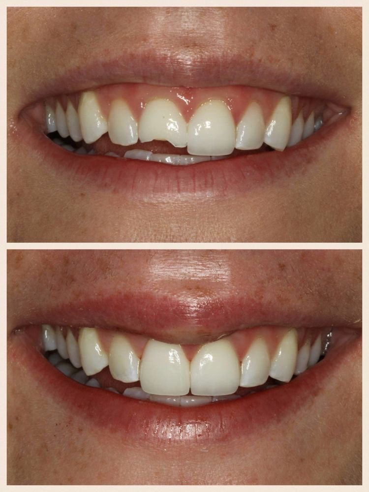 الي محتاج قلع للاسنان التالفة أو الجذور المتبقية أو حشوات للاسنان الامامية أو تنظيف للتكلسات العلاج داخل عيادات جامعة واسط مجاني وتحت اشواف اطباء اختصاص  
 :للتواصل 

*********** واتساب او تليجرام
