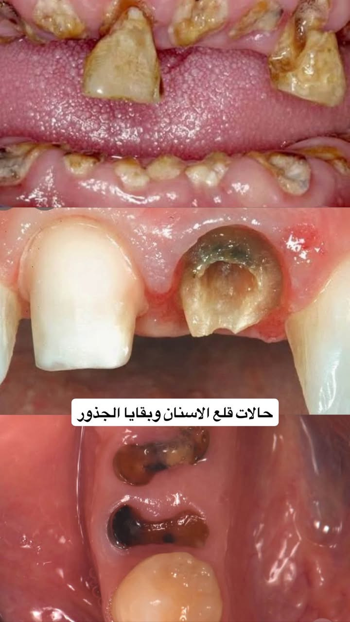 السلام عليكم💗💗
استقبال المرضى في عيادات كلية طب الأسنان في جامعة اهل البيت (ع).

المعالجة مجانية وبإشراف أخصائيين 

المعالجات المتوفرة:
🔶قلع أسنان
🔶التعويضات بأطقم متحركة
🔶 حشوات ضوئية 
🔶تنظيف الاسنان وازالة التكلسات 

الرجاء التواصل على الحسابات التالية:

الإنستغرام: 10_marb 
الواتساب:***********
