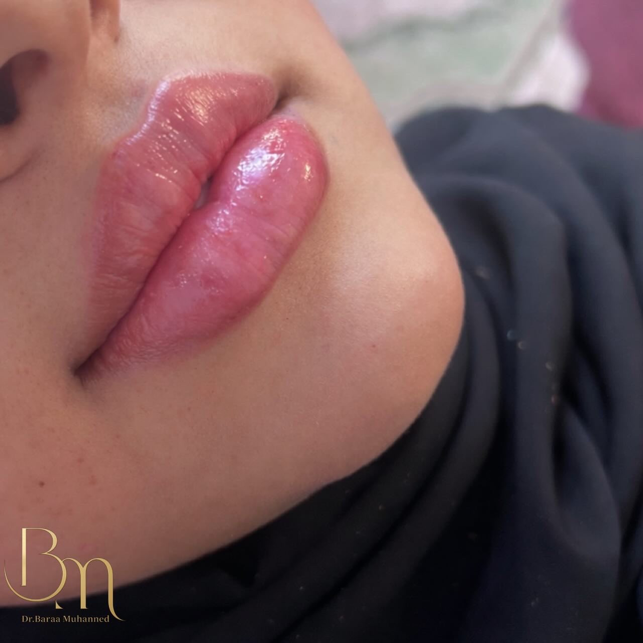 عيادة التجميل الاولى في الحسينية وتحت إشراف أطباء مختصين استغلوا آخر ايام لعروض العيد متواجدين طيلة ايام العيد للحجز السريع واتساب ***********
