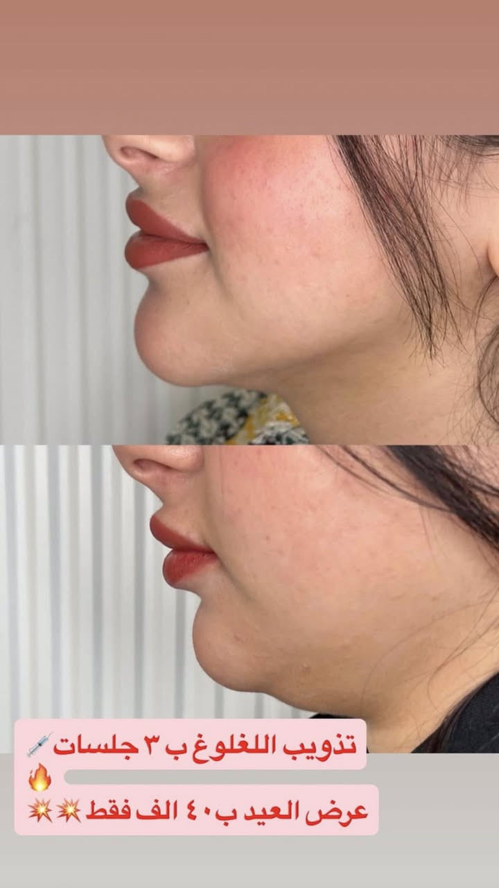 استغلوا عروض العيد من عيادة اوليفيا للتجميل
العنوان : الجريخي مجمع الصدرين الطبي الطابق الثاني 
٠***********
