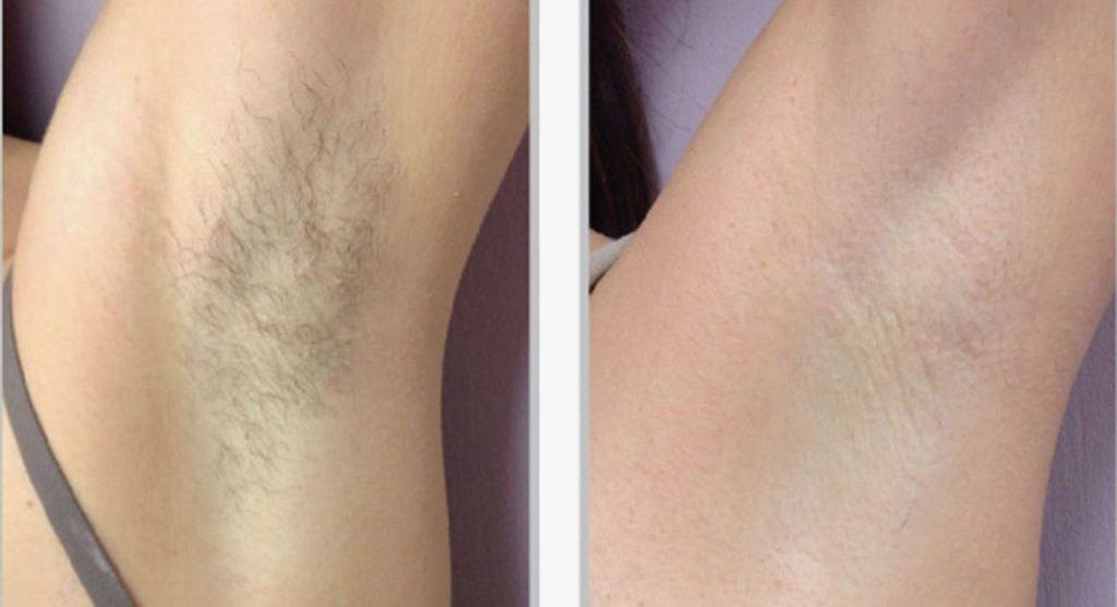 حابة تحصلين علة جسم املس وفرتلج عرض كلش راح تحبينة 🥰😍

مزيل الشعر يشيل جميع الشعر من الجسم وحتى من الوجة 

مع زيت السعد لي سوي لمعة بجسم وينعم الجلد ويقلل نمو الشعر 

يعني هم راح تخلصين من الشعر وهم راح يقل عندج نمو الشعر يجسم  

كل هذا وسعر مناسب وتوصيل مجاني لكل العراق 🏃🏻‍♀️🏃🏻‍♀️🏃🏻‍♀️


**إذا كنت صاحب هذا الإعلان وتريد حذفه لأي سبب، رجاءا أرسل رسالة إلى الدعم الفني**