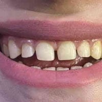 عيادة البتول • تغليف اسنان • ميسان الماجدية