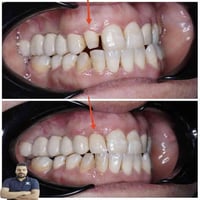 تغليف سن امامي • جلستين • المسيب شارع البلدية