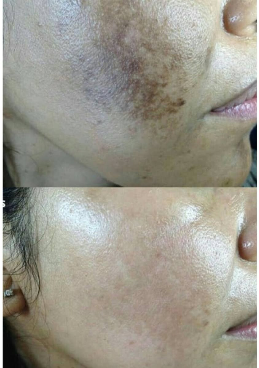 عرض ناري شبه مجاني 🏃‍♀️🏃‍♀️🏃‍♀️🏃‍♀️
تدللون علينه اميرات النجف 🥰🥰👩
العرض الاول شامل #### مع هديه ابره نضاره 
٢٥٠ الف فقط لحكووووو وتعالو العرض يمنه وبس عروض العيد عيني 🥰👩 تعالي يمنه شمنتضره العرض الثاني 
#تغير شامل مع ابره نضاره  مع بوتكس ٣٥٠الف ..... وين اكو هيج عرض.   😅 عيني سندس لحكي وتعالي. العروض يم ليلاس وبس 🥰🥰##..... العرض الثالث#تنضيف بشره عميق #مكس نضاره #بوتكس فقط ١٥٠ الف 
#العرض الرابع #ابره الطماطم 🍅 لشد وتبيض وترطيب البشره 👩‍🦰👩‍🦰 مع هديه تنضيف عميق *٥٠ الف بس  لحكووووو وتعالو. على العرض 
#العرض الخامس ###
##ابره الليمون 🍋لااذابه دهون البطن والزنود واللغلوغ  ٨٠ الف فقط. #العرض السادس  #بوتكس تعرق اجاج الصيف. اجاج الحر🥵🥵   ضايجه من مشكله التعرق المفرط. سعره فقط ١٥٠ الف فقط ##العرض الخامس. ابره الفروله 🍓🍓 حابه بشرتج تصير مثل الفروله وضاويه وجميله تعالي نسويلج ابره فروله 🍓🍓   سعره فقط ٥٠ الف. ..العروض.  العرض السابع. احقني ابره سندرلا وراح تصرين سندرلا العيد. *وجه مضيئ نضاره*  فوريه  امتلاء لطيف*. ادامه حلوه كل هاذه.** فقط ٦٥ الف منه وبس حبايب قلبي ❤️. لحكووووو وتعالو.  للحجز والاستفسار مراسلة الصفحة او الاتصال على وتساب 
***********٤ 
نجف الاشرف حي النصر بانزين خانه طريق الجنه عامود ٦٦ تنورنا وتشرفونا حبايب
