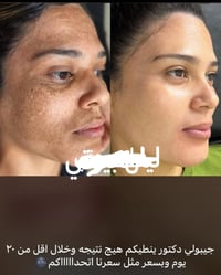 خصم • تركيبة الميلانين • للجميع