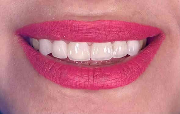 اعادة الابتسامة الجميلة والشكل الطبيعي بعد تغليف الاسنان  لمراجعتنا العزيزة
العنوان ميسان الماجدية شارع الملعب خلف مركز الشرطة امام جامع الثقلين للحجز والاستفسار 
***********
عيادة البتول لطب الاسنان عمارة
