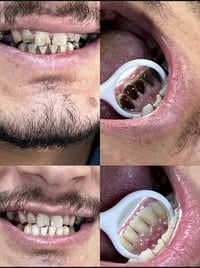 (عرض تنظيف الأسنان بسعر 15 الف فقط )في عيادة المروج مو بس تجميل... هو ...