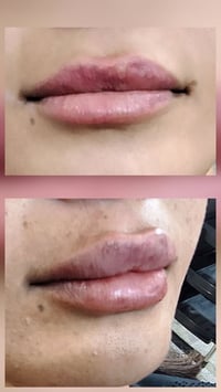 فلر شفه • ١ سي سي • الشعب