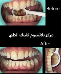 تنظيف أسنان • بلاتينيوم كلينك • المحمودية حي 17
