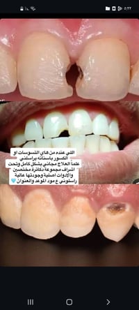 حشوات اسنان مجانية • تحت إشراف أطباء • الحلة شارع اربعين