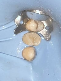 عيادة أسنان • حشوات جذور • الشورة القصبة