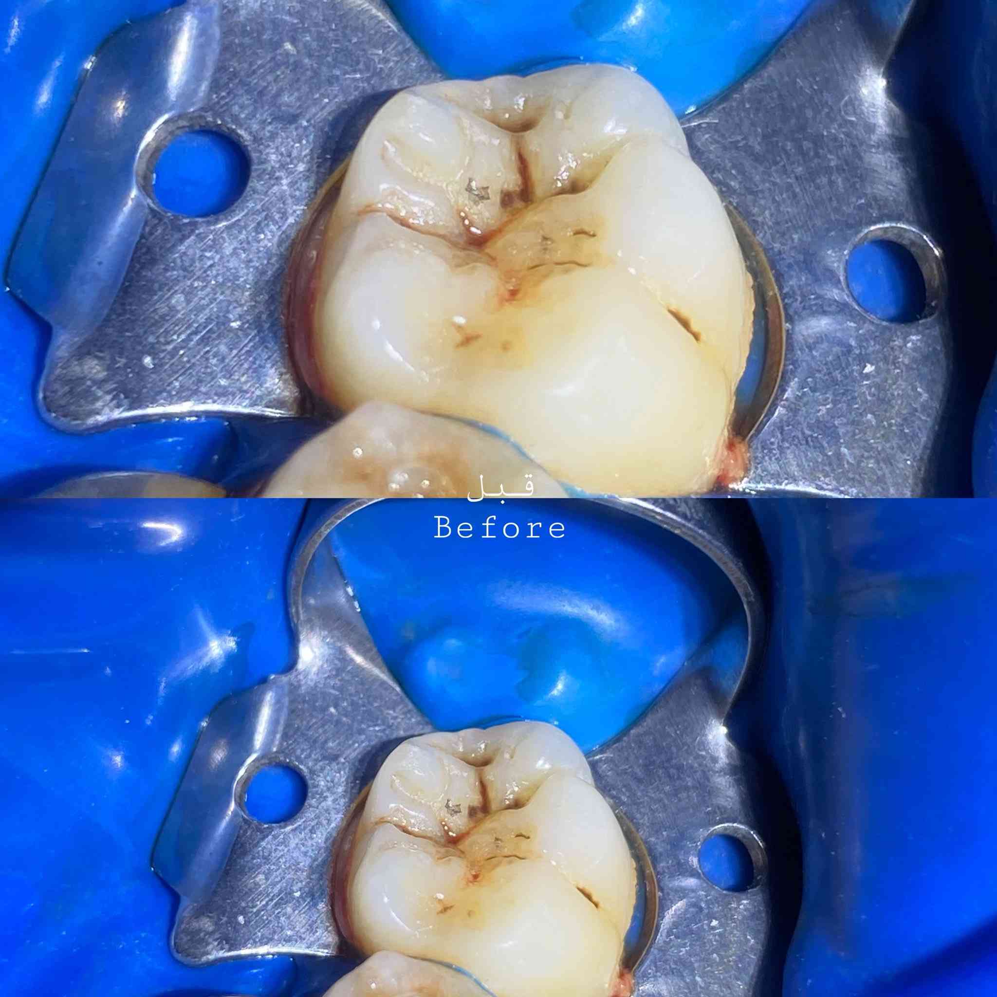 السلام عليكم ورحمة اللّٰه وبركاته 🦷🪥
الى كل من يحتاج رعاية طبية لأسنانه وذلك من

🔴حشوات تجميلية بيضاء
🔴حشوات جذور
🔴قلع الاسنان التالفة او الجذور المتبقية
🔴تنطيف التكلسات القوية
🔴قلع أسنان الاطفال
🔴تقويم أسنان للاطفال
جميع هذه الخدمات متوفرة في العيادات التعليمية لجامعة ذي قار علماً بأن العلاج مجاني ماعدا تكلفة الباص .
وهذه بعض من الحالات التي تم علاجها على يد 
الدكتورة: غدير جاسم محمد / المرحلة الخامسة
العنوان: حي اور / كلية طب الاسنان مقابل مستشفى الحسين التعليمي فرع الطب العدلي
للحجز: التواصل على الخاص او الرقم *********** او على حساب الانستكرام
gh_clinic0
