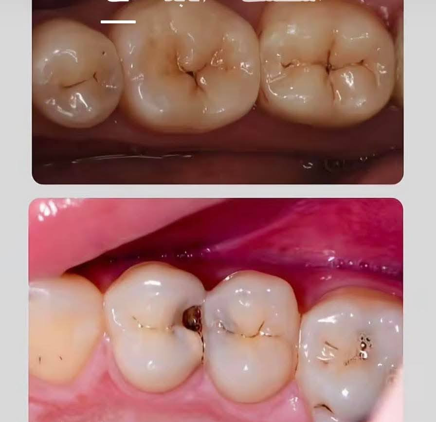 الي محتاج حشوه للاسنان للحالات الي موجوده بالصور أو تعويض الاسنان بطقم جزئي متحرك
او قلع الاسنان التالفه 
علما بان العلاج مجاني وتحت إشراف كادر طبي مختص 
العنوان جامعه الوطنيه مجاور ملعب التضحيه 
***********
