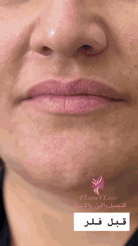 #عيادة فلورا للتجميل والليزر والاسنان 

#جلسه فلر شفه حسب طلب المراجعة ❤️

 #العنوان؛ طوز _ سوك الجمهوريه  _ مجاور ملبوسات مختار 
طابق تأني لجامعة 
الرقم؛ ***********📞

#علما_ليس_لدينا_فرع_اخر 🧿
