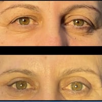عمليات قص الأجفان متوفرة الآن بعيادتنا  بغداد ناحيه الرشيد السوق  0777...